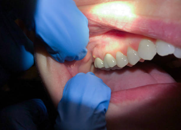 Best Emergency Wisdom Tooth Extraction in Tolar, TX