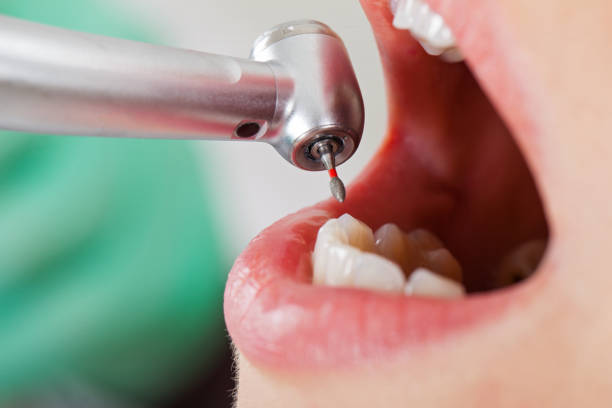 Best Emergency Wisdom Tooth Extraction in Tolar, TX